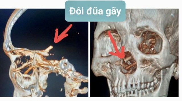 Phẫu thuật lấy đôi đũa đâm xuyên từ mũi vào não bệnh nhân -0