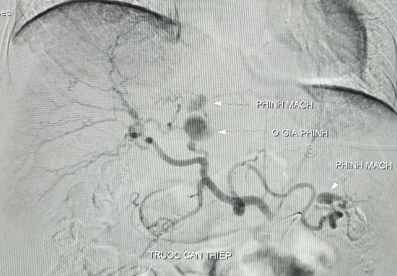 Cứu sống bệnh nhân vỡ phình động mạch gan rất hiếm gặp -0