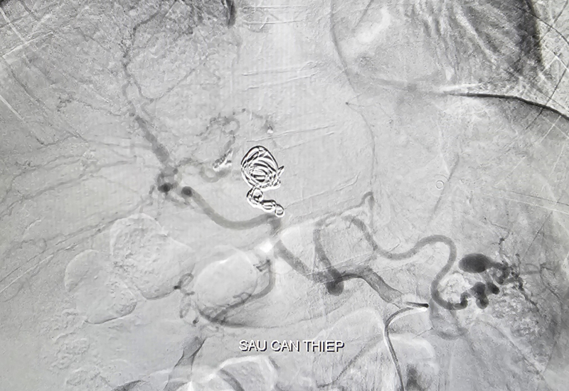 Cứu sống bệnh nhân vỡ phình động mạch gan rất hiếm gặp -0