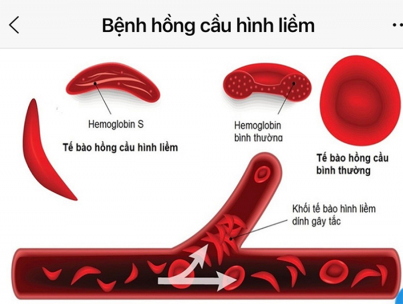 FDA đã thông qua liệu pháp gen đầu tiên cho bệnh tật của con người -0