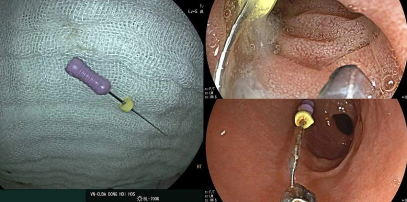 Trẻ 5 tuổi nuốt phải  nuốt kim nha khoa có kích thước khoảng 2,5cm. -0