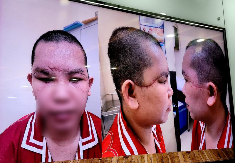 Nữ công nhân bị máy cuốn sợi quấn vào tóc kéo tróc toàn bộ da đầu  -0