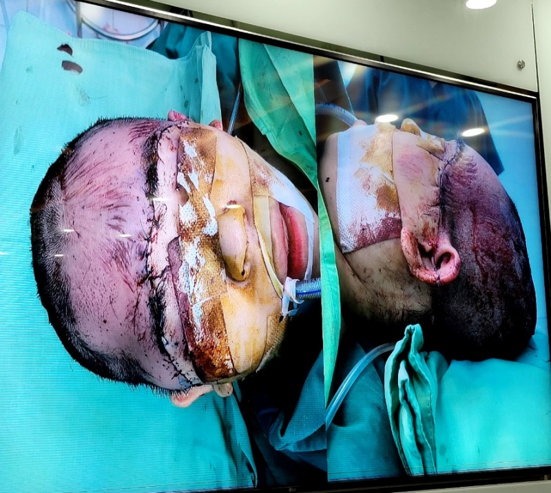 Nữ công nhân bị máy cuốn sợi quấn vào tóc kéo tróc toàn bộ da đầu  -1