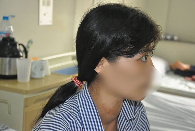 Biến chứng tử vong khi điều trị Basedow không đúng cách -0