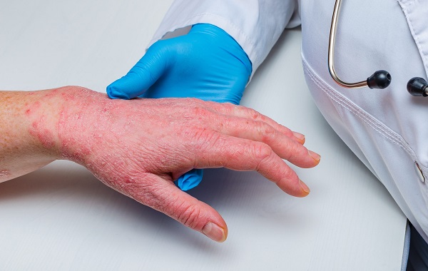 Gia tăng mắc da liễu do thời tiết nồm ẩm -0