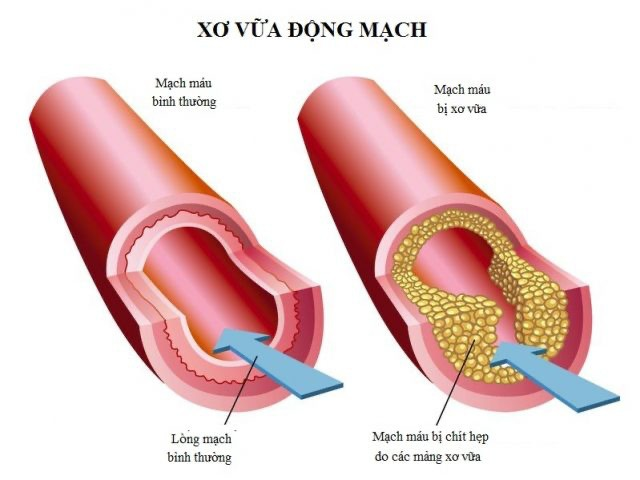 Phòng ngừa và điều trị đột quỵ bằng một hợp chất tự nhiên có trong bông cải xanh -0