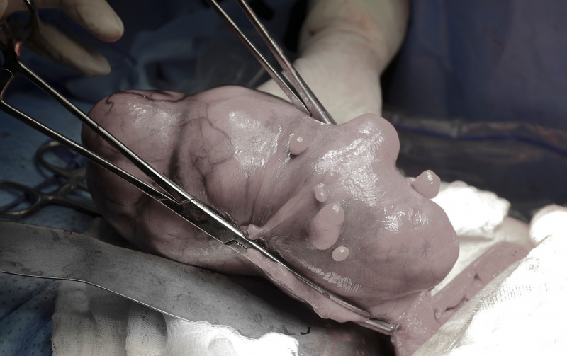 Nữ bệnh nhân 57 tuổi 