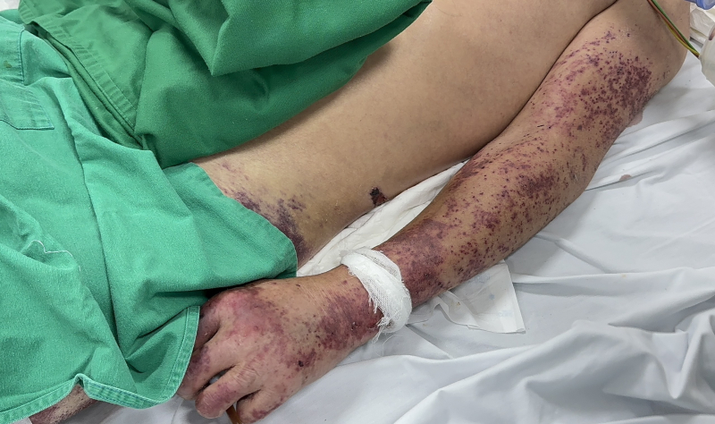 Mua thủ lợn về chế biến, người đàn ông mắc liên cầu nguy kịch -0