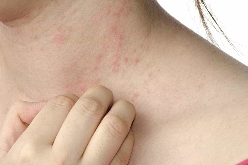 3 trường hợp trẻ tử vong, TP Hồ Chí Minh cảnh báo nguy cơ về dịch sởi  -0