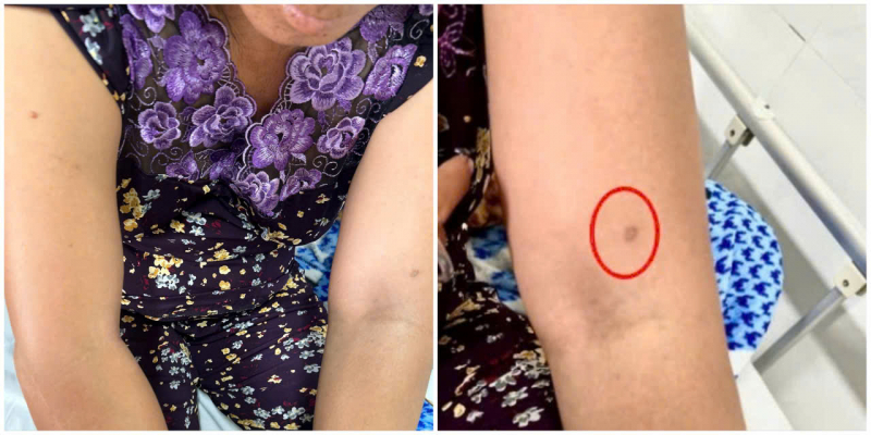 Cảnh báo liên tục nhiều trường hợp sốc phản vệ do ong vò vẽ đốt -0