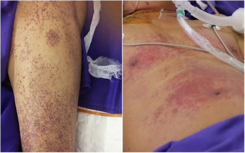 Một thợ xây mắc bệnh lý nguy hiểm do nhiễm liên cầu lợn  -0