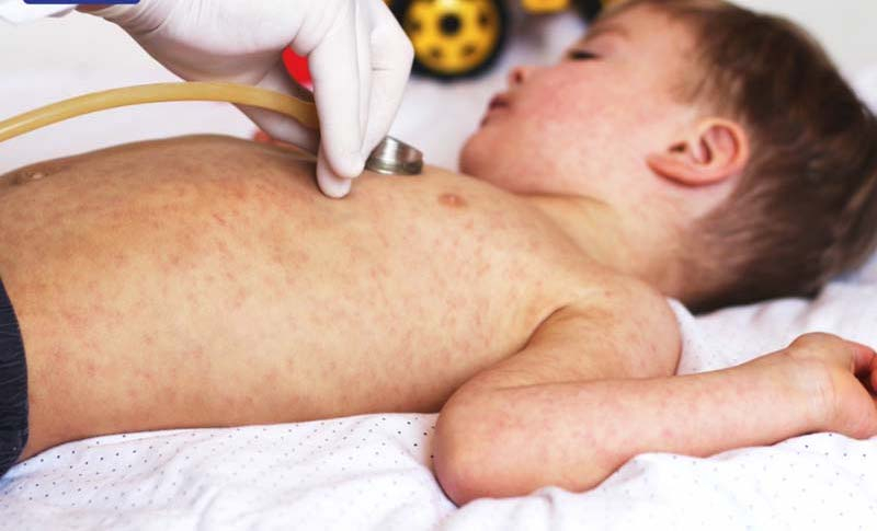 Mở rộng tiêm vaccine sởi ra nhiều tỉnh, thành phố -0