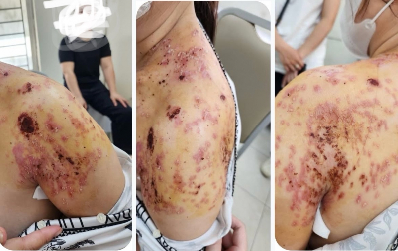 Bó lá điều trị gãy xương đòn, người phụ nữ ở Hà Nội bị bỏng da và nhiễm trùng da nặng vì bó lá -0