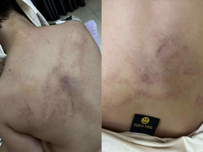 Điều tra vụ bé gái 4 tuổi bị giáo viên mầm non đánh đập, kéo lê, ném vào tường ở phường Bồ Đề -0