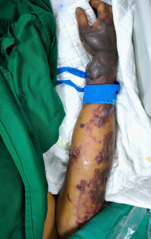 Ăn tiết canh ở quán quen, người đàn ông ngừng tim nguy kịch -0