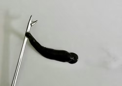 Đỉa suối dài 4cm trong mũi thiếu niên 14 tuổi -0
