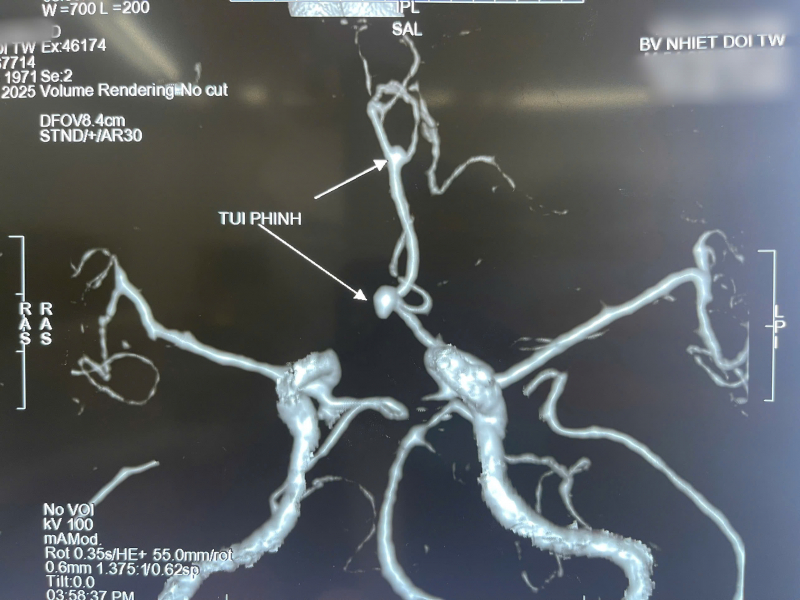 phình não1.jpg -0