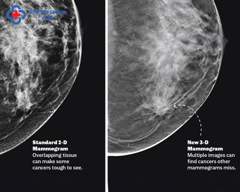 Phát hiện ung thư ở cả 2 vú khi chụp nhũ ảnh 3D -0