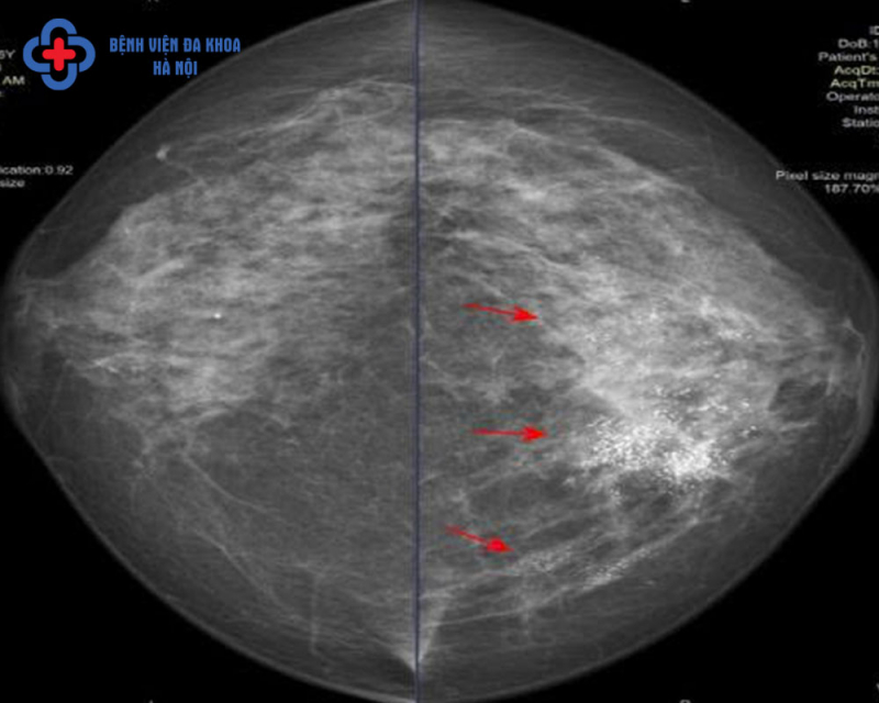 Phát hiện ung thư ở cả 2 vú khi chụp nhũ ảnh 3D -0