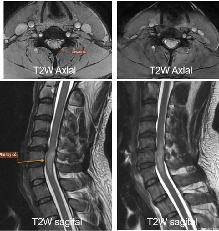 Từ nỗi lo liệt tứ chi đến hành trình hồi sinh tại Bệnh viện Mặt Trời -0