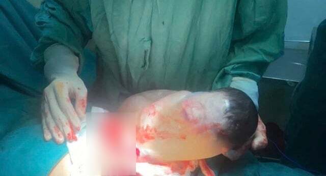 Hiếm gặp: Bé trai sinh ra trong bọc điều -0