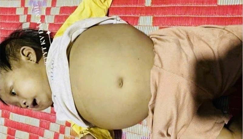 Công an hỗ trợ, kêu gọi giúp đỡ bé gái 17 tháng tuổi mắc bệnh xơ gan -0