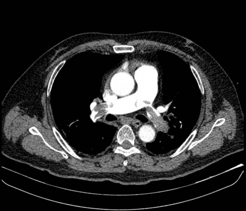 thuyên tắc phổi.png -0