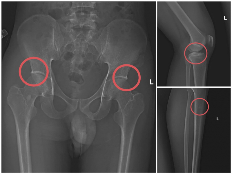 Bắt giữ ổ nhóm tự đục vỡ xương khớp nhằm chiếm đoạt tiền bảo hiểm -0