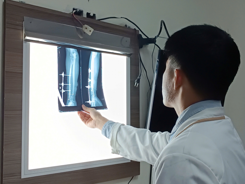 Lindningsmaskin avhugger manlig arbetares underarm under arbete -2