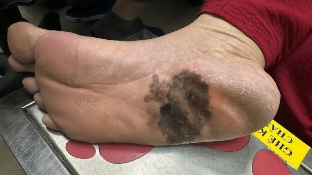 Veel mensen gaan naar de dokter vanwege huidkanker door zwarte vlekken op de voetzolen -0