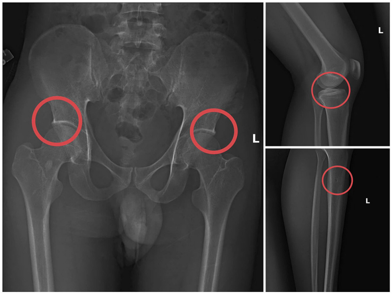 Hành vi man rợ của các đối tượng câu kết đục xương để trục lợi bảo hiểm -0