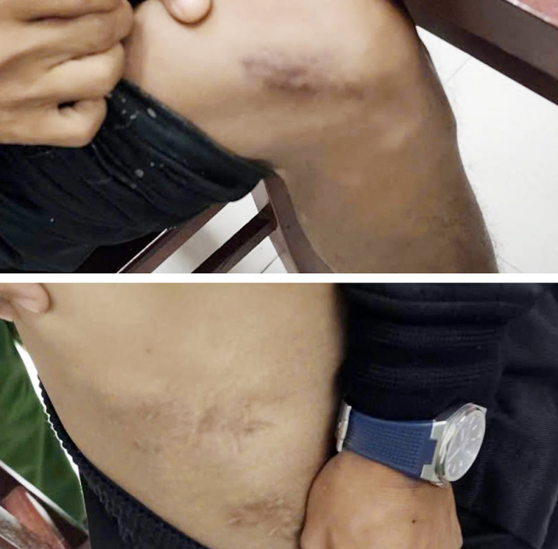 Hành vi man rợ của các đối tượng câu kết đục xương để trục lợi bảo hiểm -0