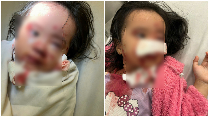Bé gái 5 tuổi bị chó cắn gây thương tích nặng ở mặt khi chơi trong công viên -0
