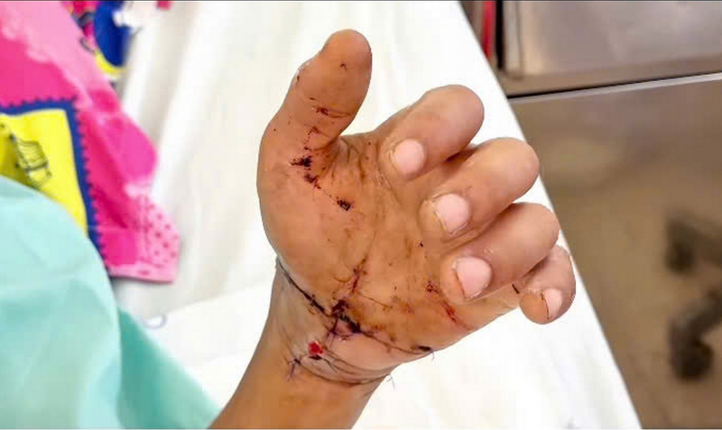 Sau ca vi phẫu 8 giờ xuyên đêm cổ tay bệnh nhân bị đứt lìa được nối lại thành công -0