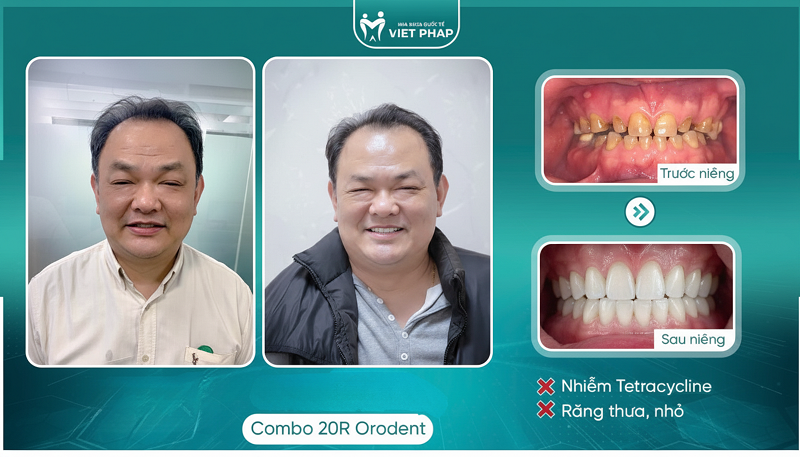 Bọc răng sứ đón Tết – làm đúng để không “mất Tết” -0