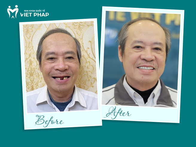 Tết trọn vị sum vầy nhờ giải pháp trồng răng Implant hiện đại -0