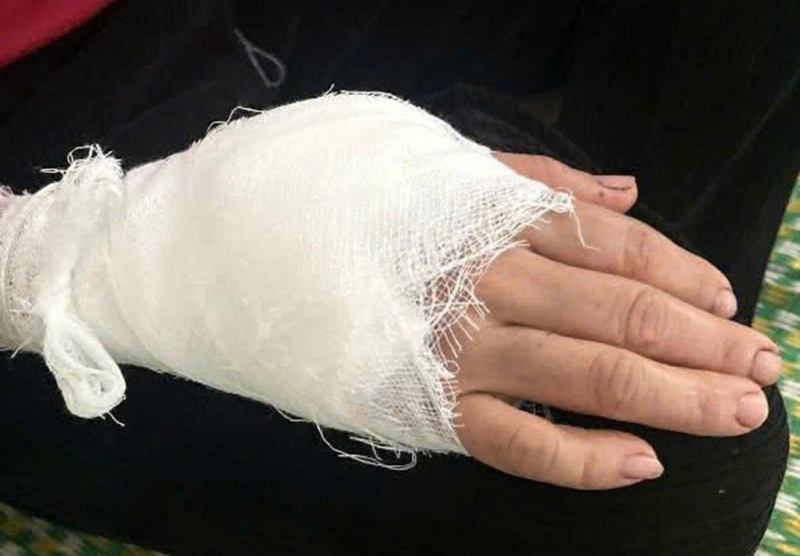 Một con khỉ hoang tấn công người phụ nữ ở Thanh Hoá khâu 15 mũi -0