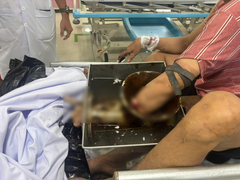 Nguy cơ tiềm ẩn và những hậu quả khó lường từ máy xay thịt -0