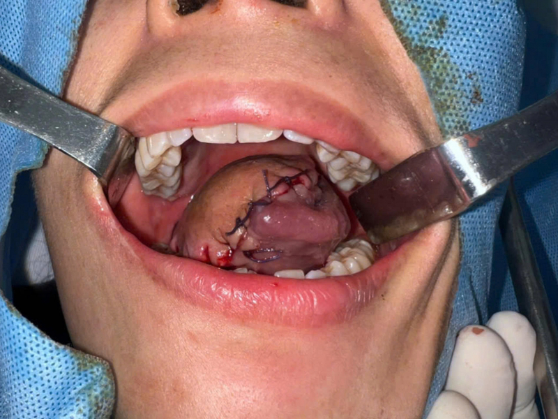 Tái tạo lưỡi cho bệnh nhân ung thư bằng vạt đùi: Đừng bỏ qua những dấu hiệu bất thường -0