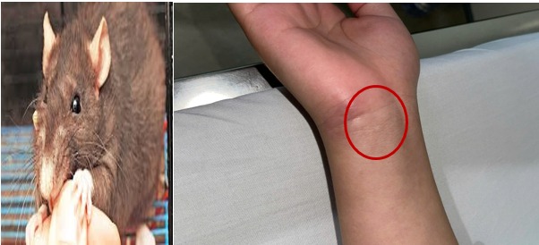 Thiếu niên mắc bệnh nguy hiểm sau khi bị chuột cắn -0