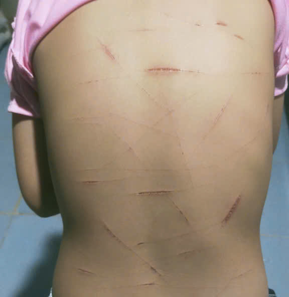 Điều tra vụ nữ sinh lớp 5 ở Cà Mau bị nhiều vết thương trên cơ thể -1