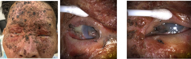 Nhiều trường hợp chấn thương mắt nặng do pháo, có trường hợp phải bỏ nhãn cầu  -1