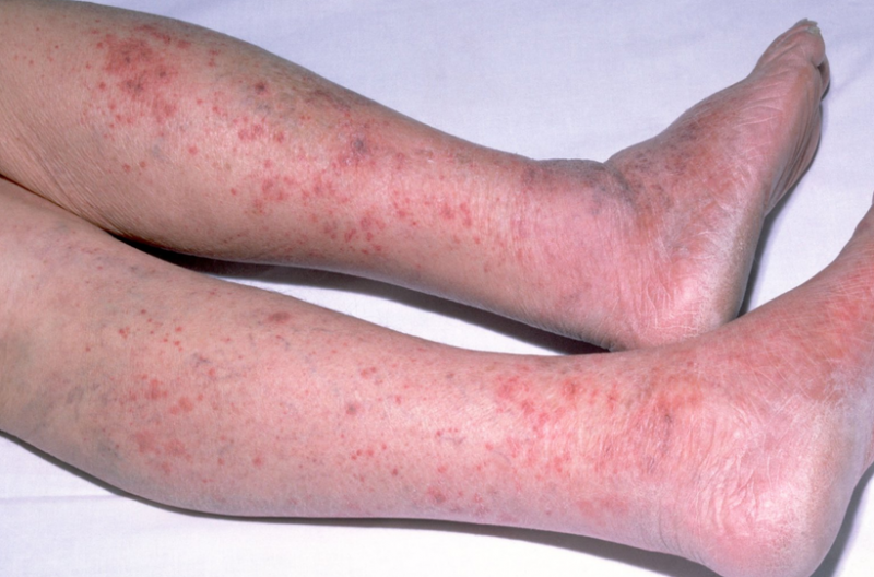 Lo ngại viêm não mô cầu, nhiều người đi tiêm chủng -0