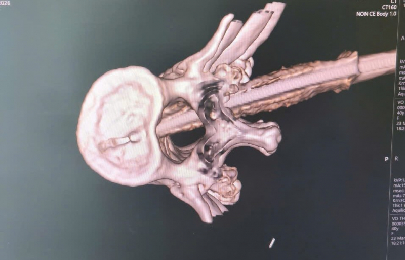 Nữ bệnh nhân bị dao đâm xuyên lưng: Cuộc giải cứu nghẹt thở từ 