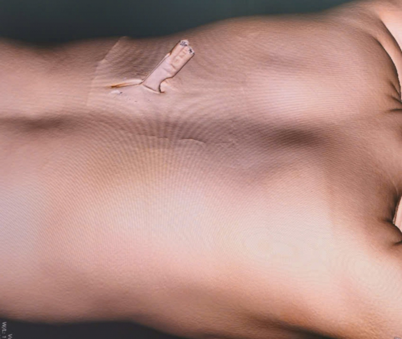 Nữ bệnh nhân bị dao đâm xuyên lưng: Cuộc giải cứu nghẹt thở từ 