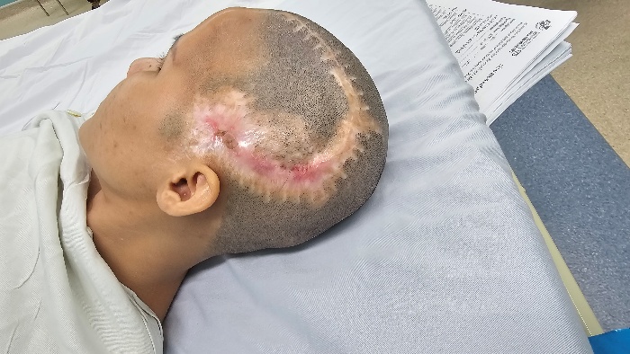 Phẫu thuật thành công trường hợp sẹo rộng vùng khuyết sọ sau biến chứng thẩm mỹ -0