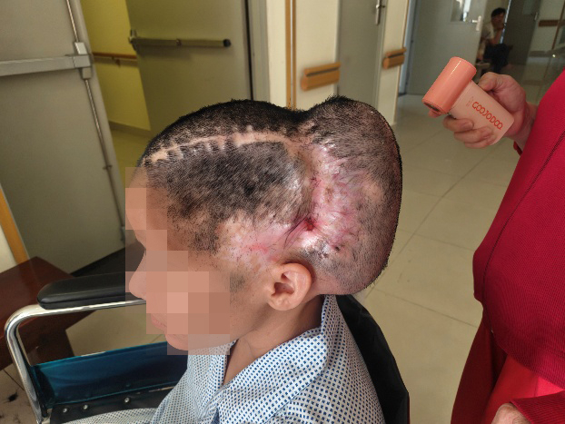 Phẫu thuật thành công trường hợp sẹo rộng vùng khuyết sọ sau biến chứng thẩm mỹ -1