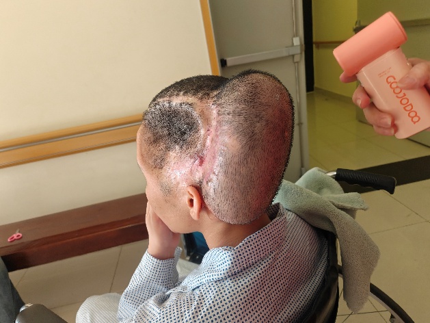 Phẫu thuật thành công trường hợp sẹo rộng vùng khuyết sọ sau biến chứng thẩm mỹ -2