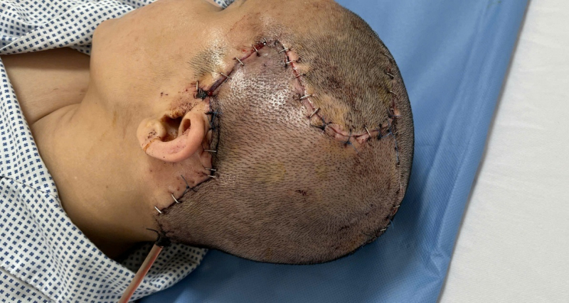 Phẫu thuật thành công trường hợp sẹo rộng vùng khuyết sọ sau biến chứng thẩm mỹ -3