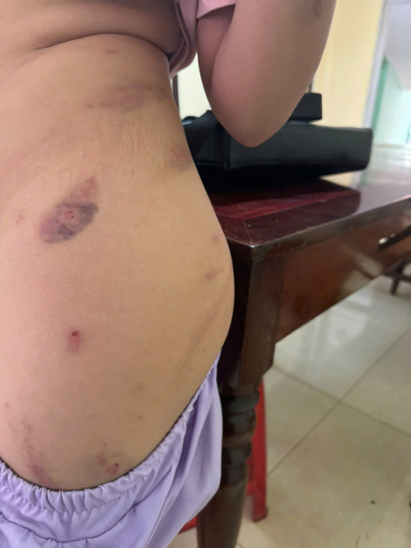 Công an xác minh điều tra vụ bé gái 9 tuổi bị đánh chi chít vết thương trên người -0